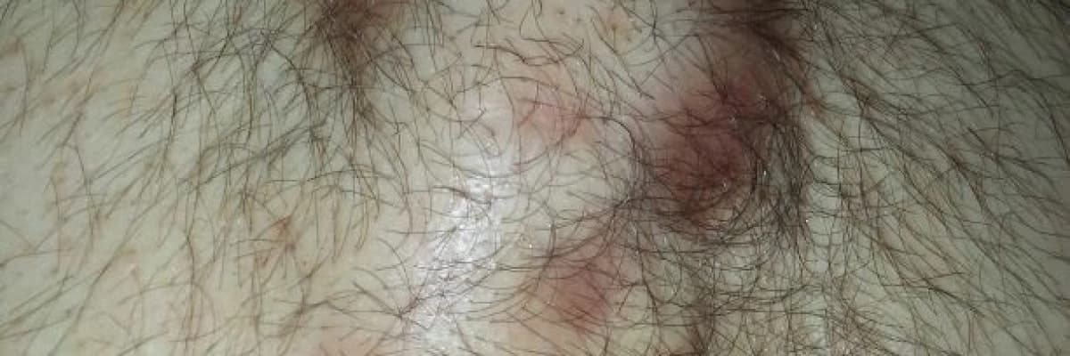 Kıl dönmesi apsesi