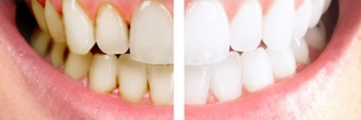 BEYAZLATMA KABUSUNUZ OLMASIN!