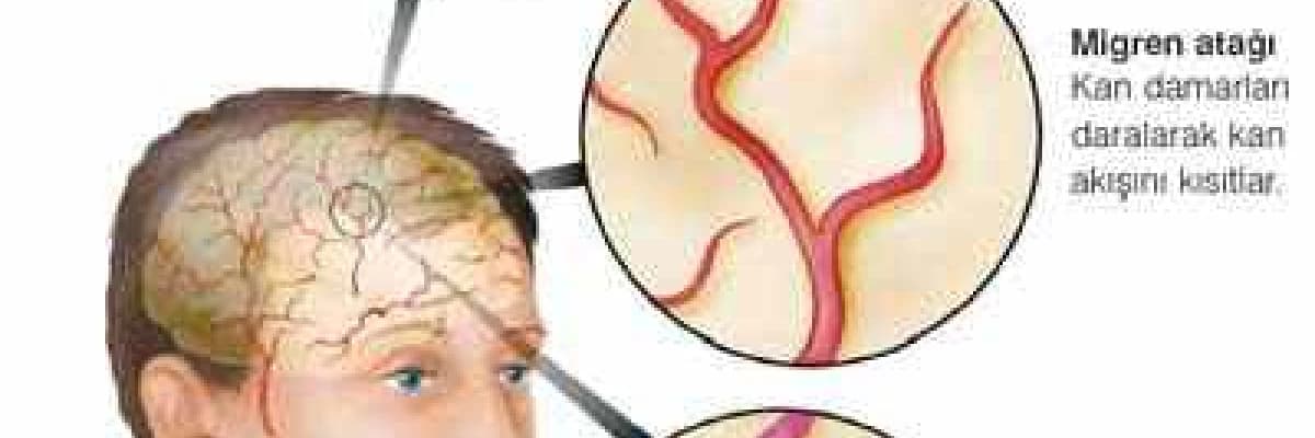 Migren tedavisinde kuruiğneleme ve manuel terapi