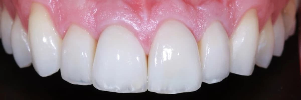 Estetik diş tasarımında dişeti