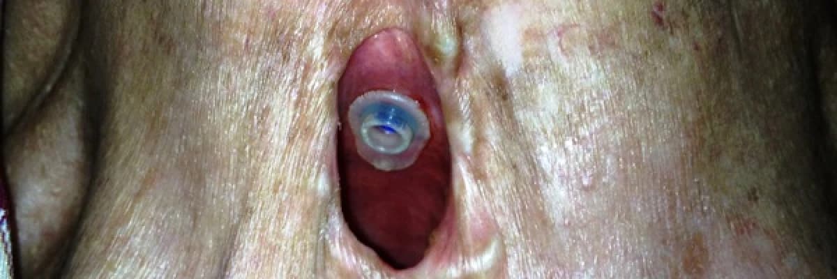 Gırtlak kanserli hastalarda konuşma protezi