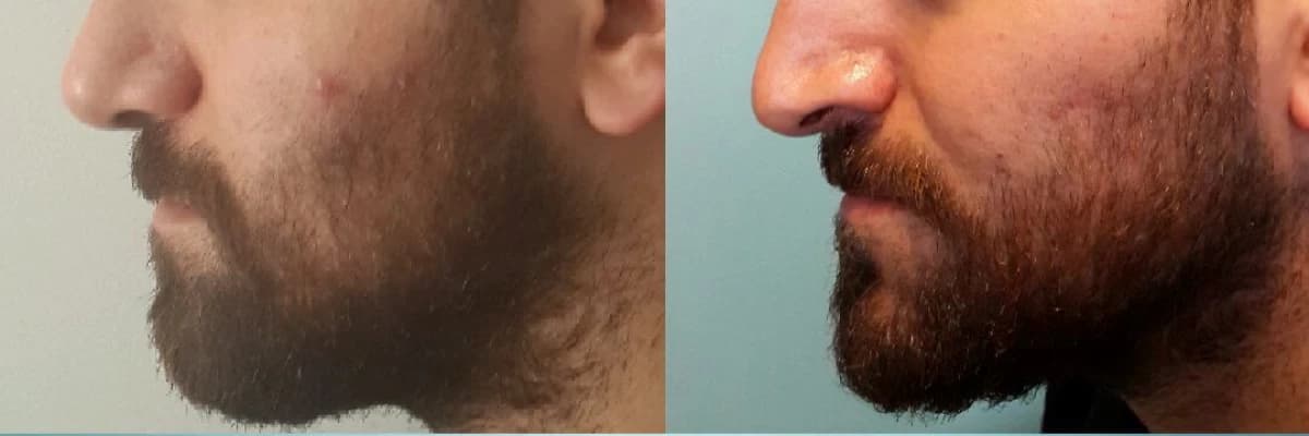 Burunda şekil bozukluğu beden sağlığını tehdit edebilir!!