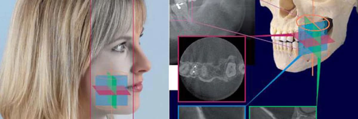 Volumetrik diş tomografisi