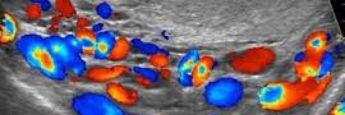 Skrotal varikosel renkli doppler ultrasonografi