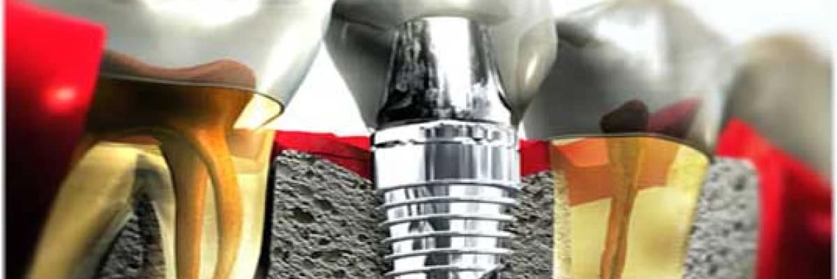 İmplant öncesi hazırlık