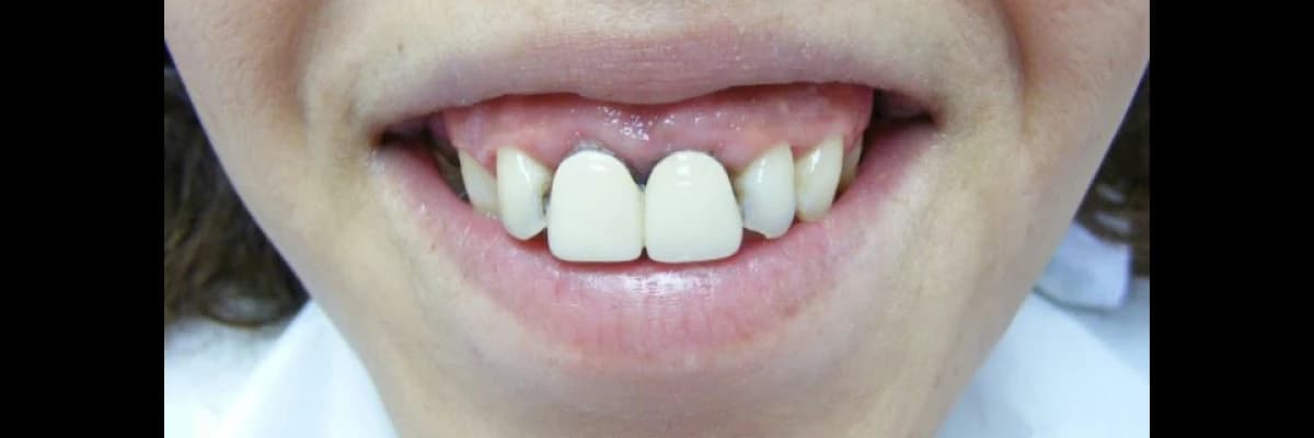 Gingivoplasti gingivektomi