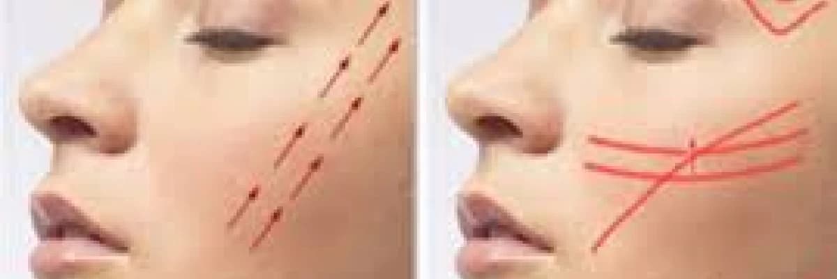 Organik lifting nedir?