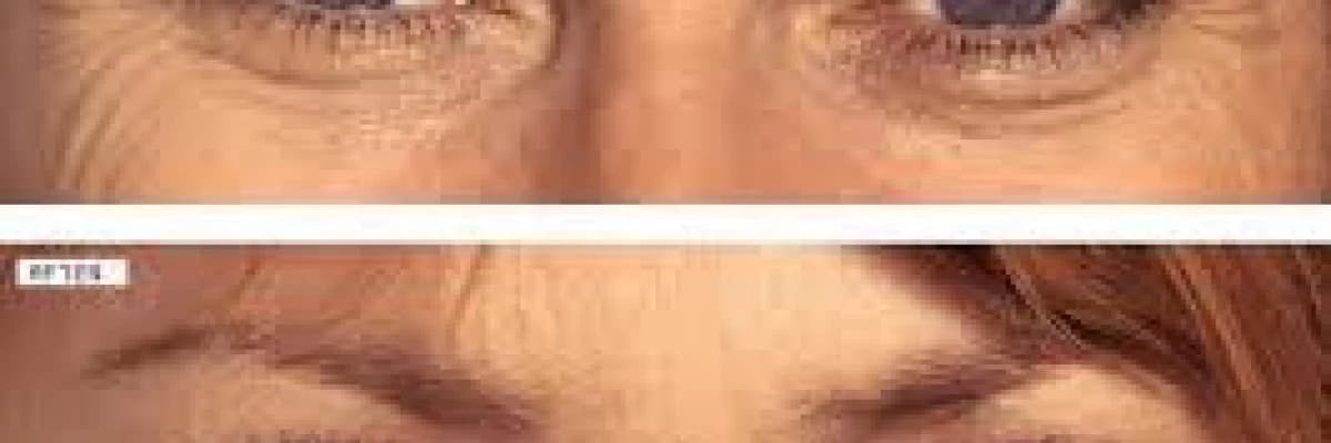 Botox  uygulamaları