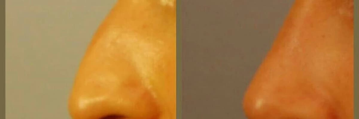 Bir burun estetiğinden beklenmesi gereken 3 şey;