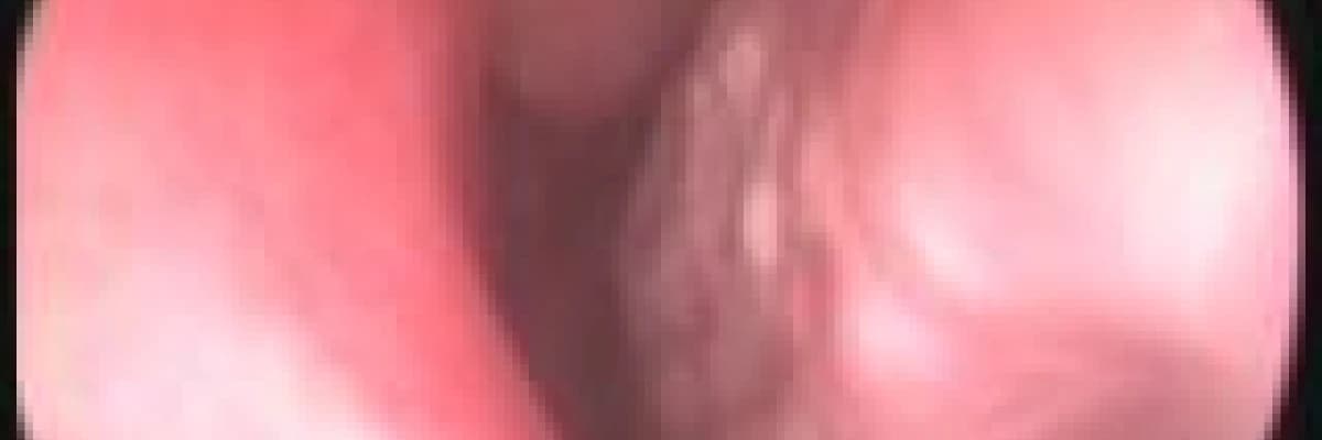 Burun eti ameliyatı