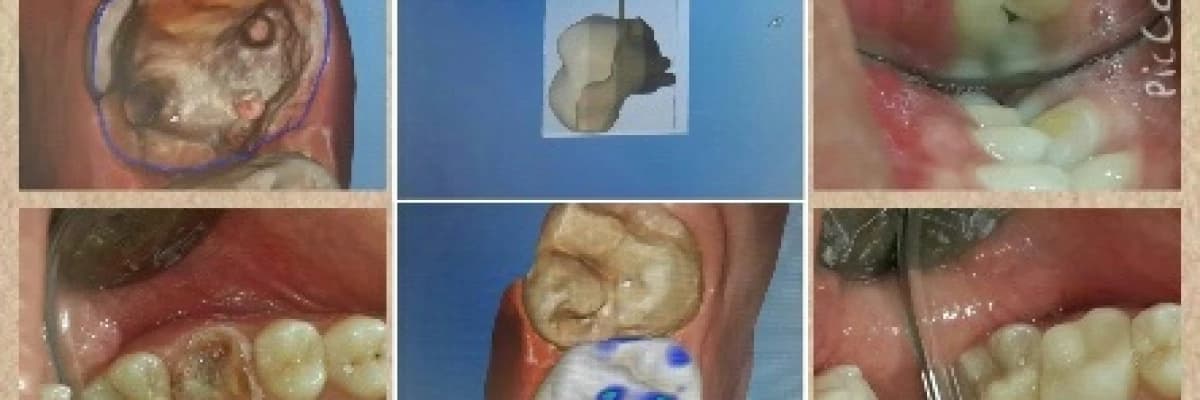 Dijital diş hekimliği’nde cad/cam