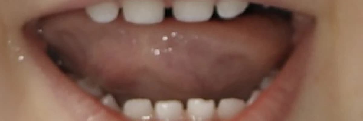 Çocukluk döneminde dişeti hastalıkları