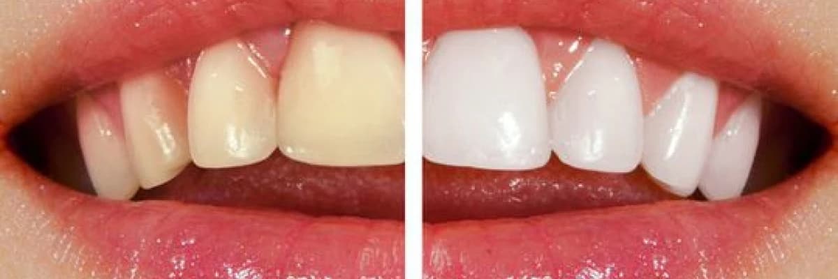 Diş beyazlatmanın (bleaching) ömrü ne kadardır ?