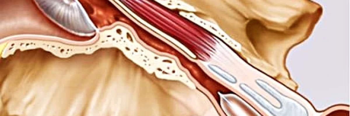 Balon kateter kalpten sonra; kulak hastalıklarının tedavisinde