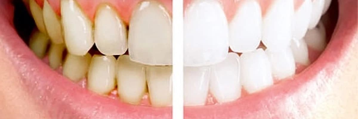 Beyaz düşlerininizi bembeyaz gülüşlerle taçlandırın