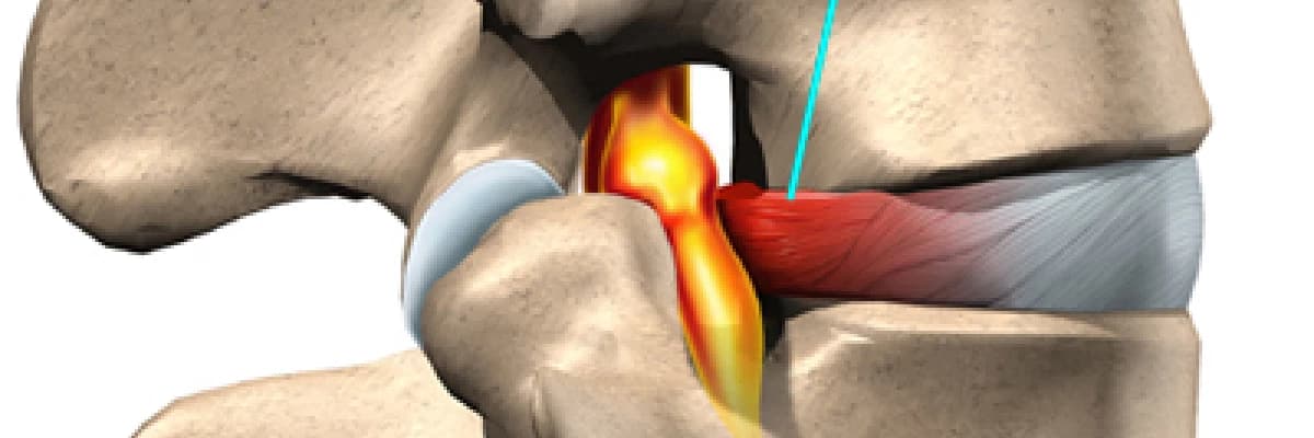 Günümüzde bel fıtığı ne sıklıkta görülüyor? Tedavisi? İlaç tedavisi yeterli mi? Ameliyat şart mı?