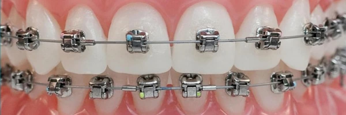 Ortodontik tedaviye başladığınızda sizi bekleyenler...