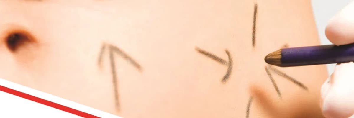 Mini karın germe ameliyatı (abdominoplasti ameliyatı)