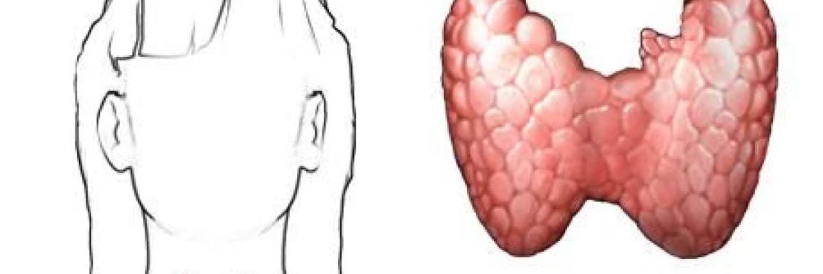 Gebelikte tiroid bezi hastalıkları (guatr ve diğerleri)