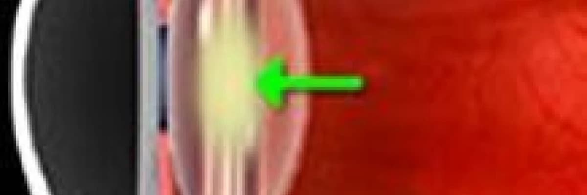 Katarakt nedir? Tedavisi nasıldır?