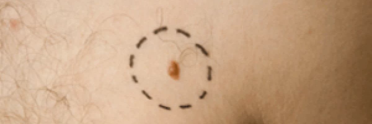 Deri kanserleri Hakkında