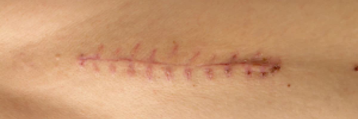 Yara izi ve tedavisi