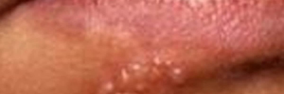 Uçuk ve aft lezyonları