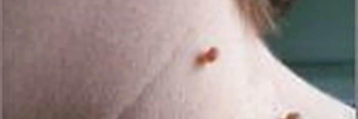 Lazer ile et benlerinin alınması