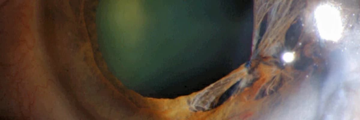 Puppıloplasty nedir?