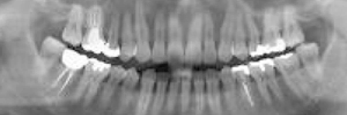 Panoramik diş filmi