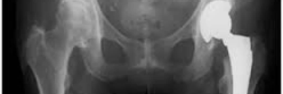 Total kalça protezi rehabilitasyonu