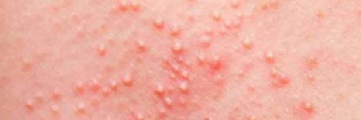 Genital siğiller (HPV) enfeksiyonu nedir?