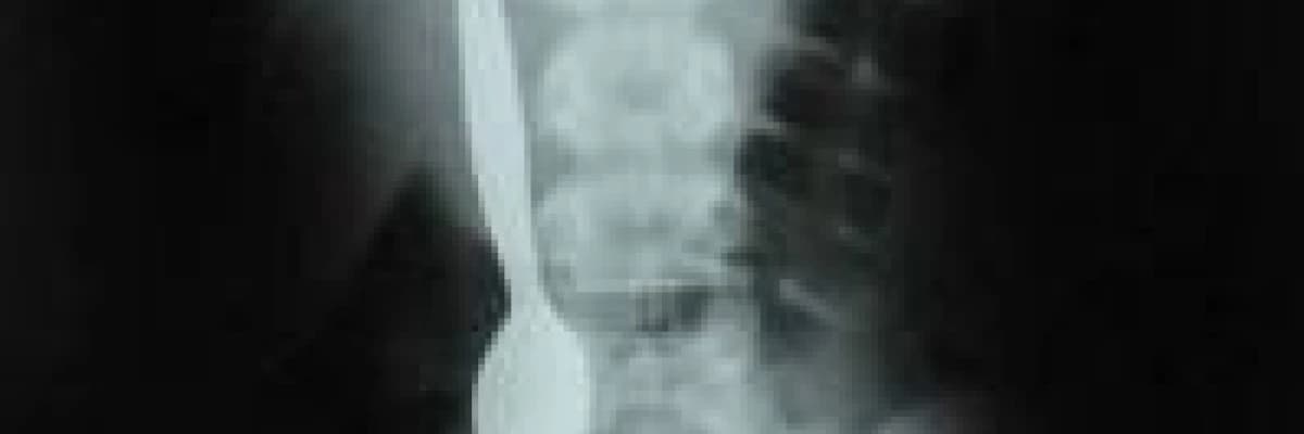 Çocuklarda endoskopi ile yabancı cisim çıkarılması