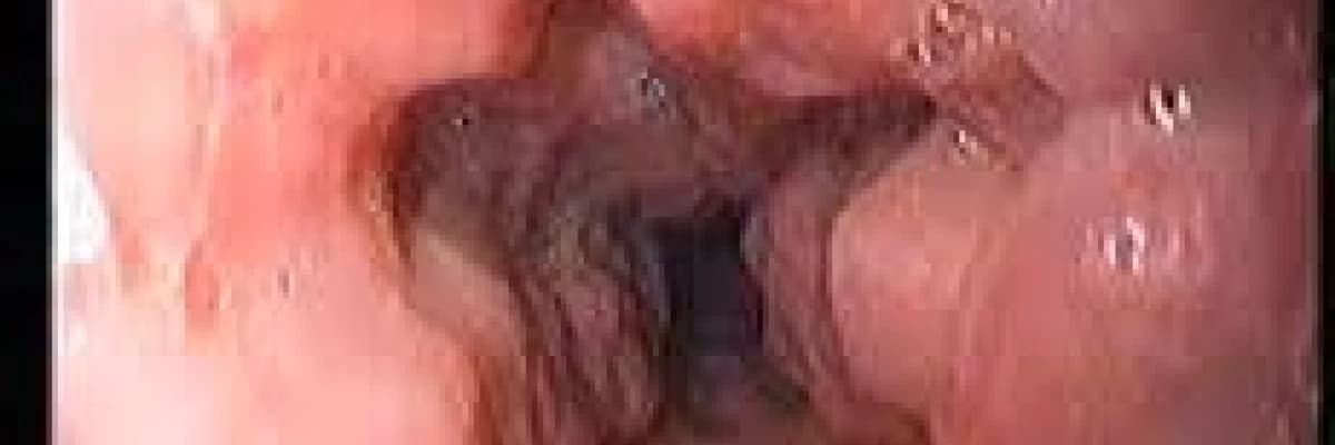 Yemek borusu varisi tedavisi