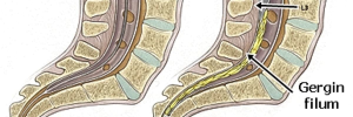 Gergin omurilik sendromu