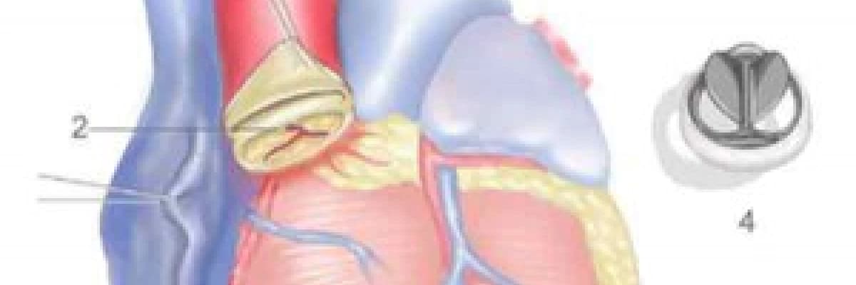 Aort kapak ameliyatı