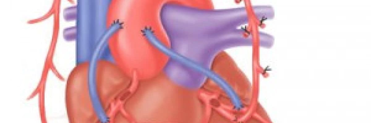 Koroner bypass – baypas ameliyatı