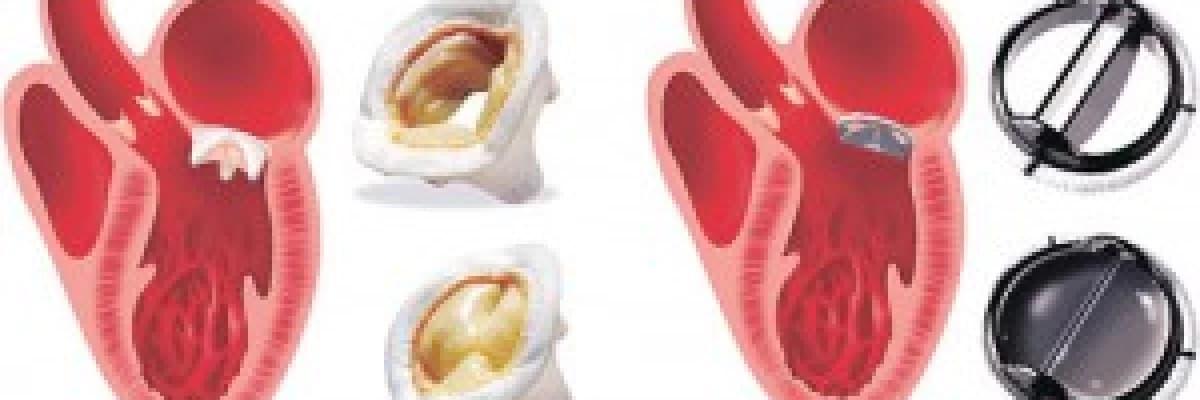 Mitral kapak ameliyatı