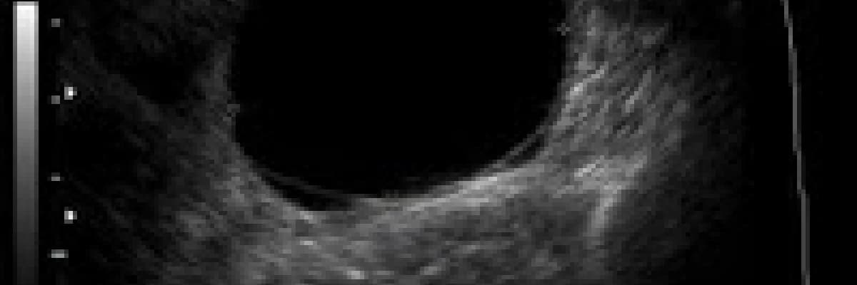 Kist tedavisi ve ameliyatları
