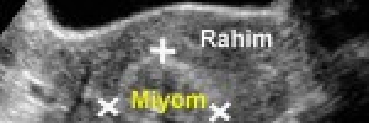 Hamilelik ve miyomlar