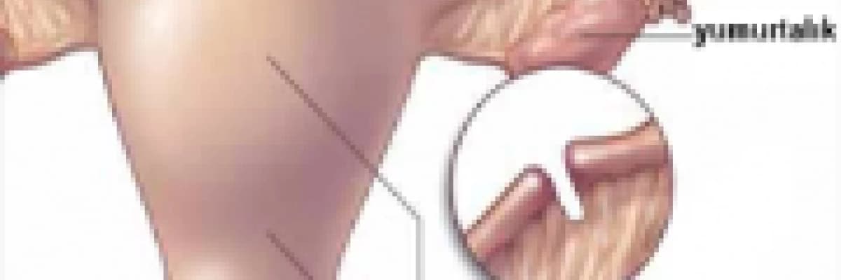 Kadında tüplerin bağlanması