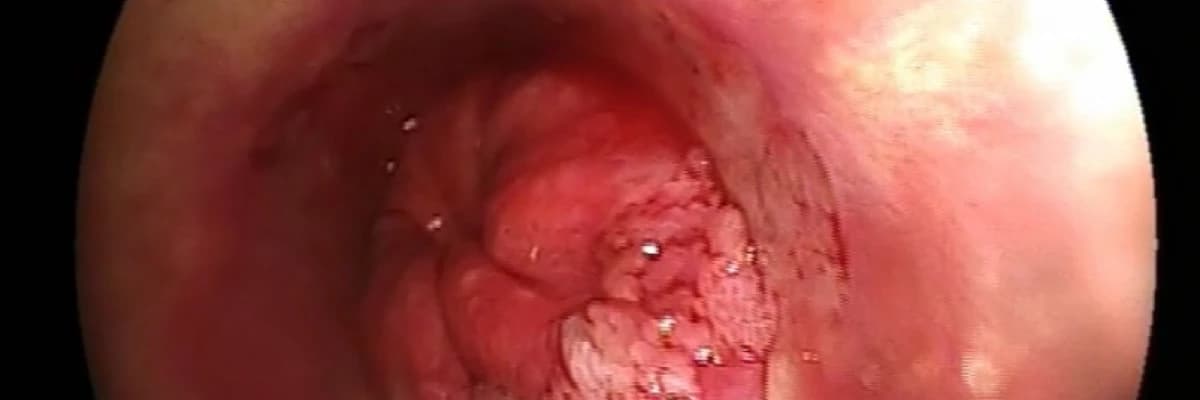 Kolon kanseri, nedenleri, tanı ve tedavisi