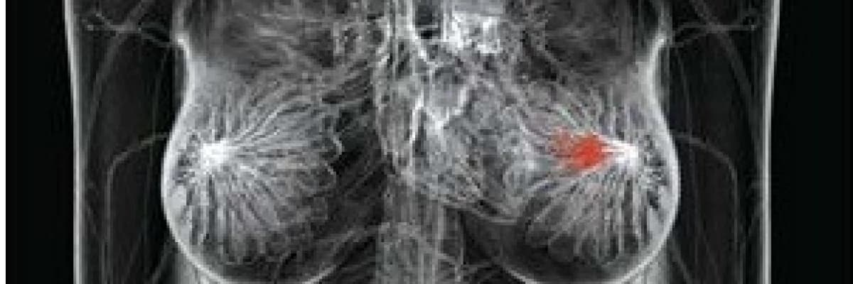 Meme kanserli hastada tedavi başarısının bağlı olduğu faktörler