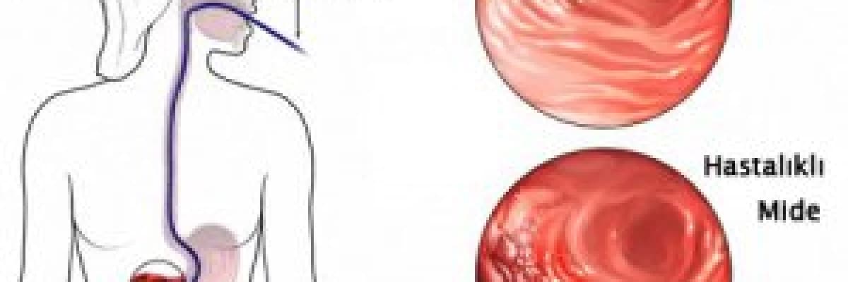 Endoskopik ultrasonografi