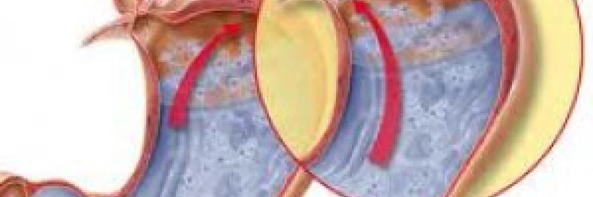 Gastroözofageal reflü hastalığı