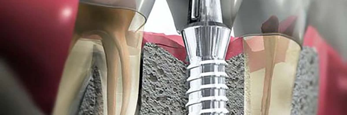 Diş implantı ( dental implant)