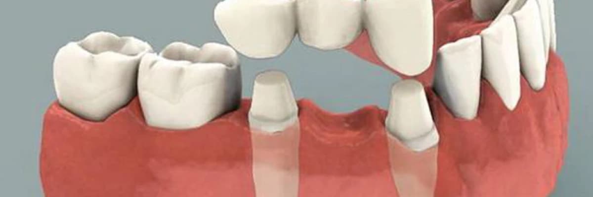 Kaç çeşit köprü restorasyon vardır?