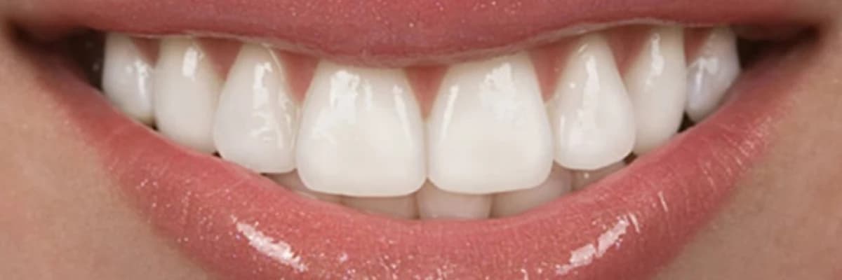 Tek diş porselen kuron restorasyonlar