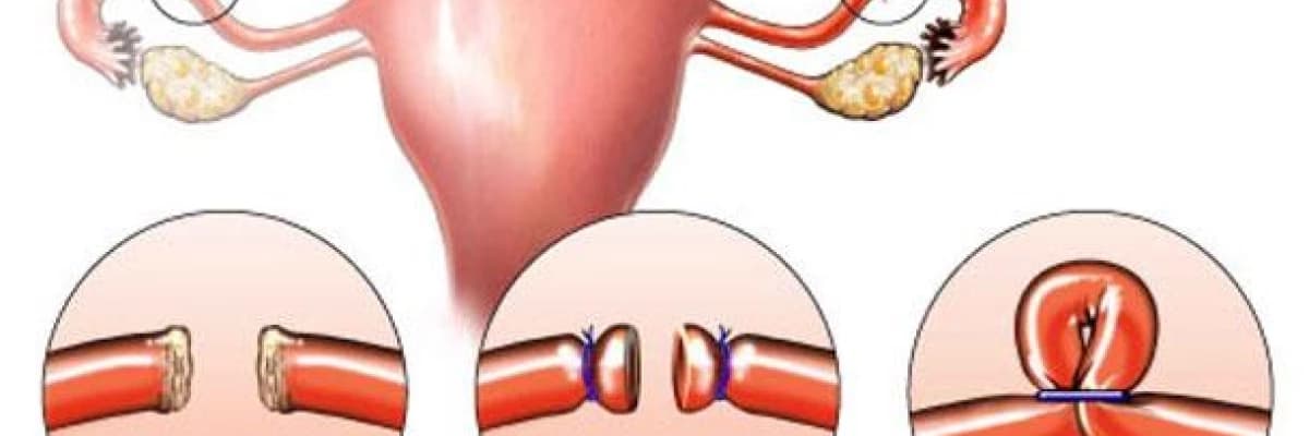 Tüp bağlama yöntemi ile doğum kontrolü