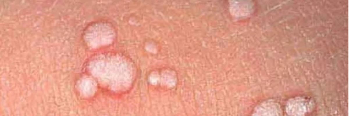 Genital siğil ve tedavi yontemleri